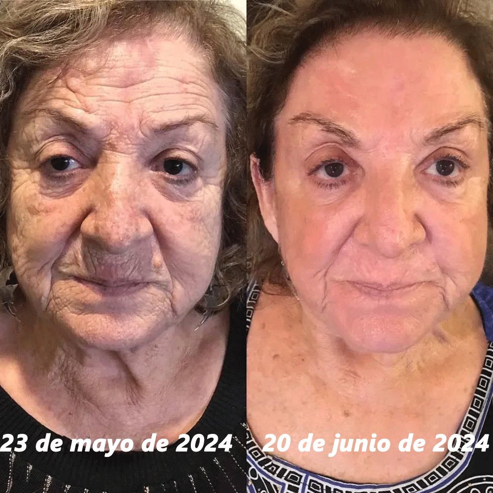 CREMA DE BOTOX VENENO DE ABEJA