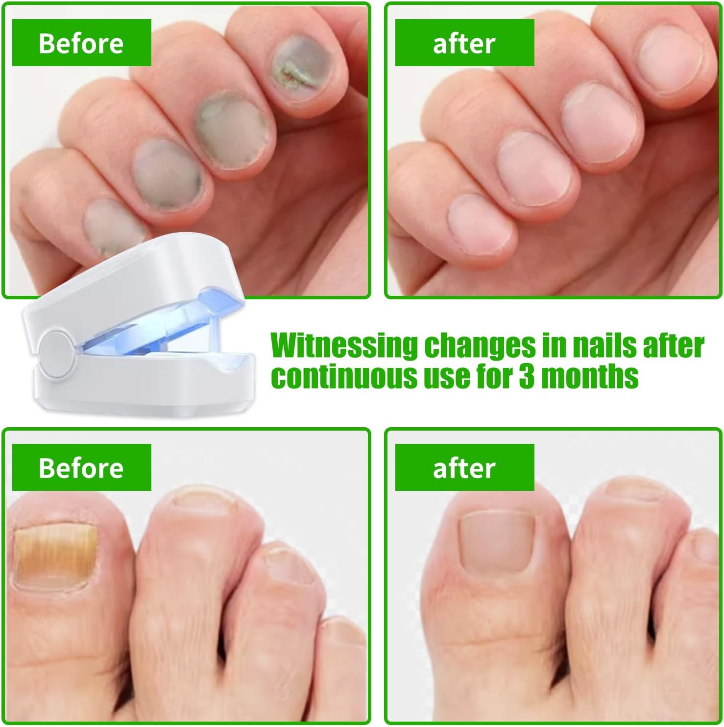 Laser Curador de Hongos